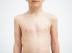 Monkeypox cases reported in children